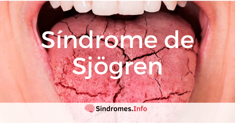 Todo Sobre El Sindrome De Sjogren Y Tratamiento 7065